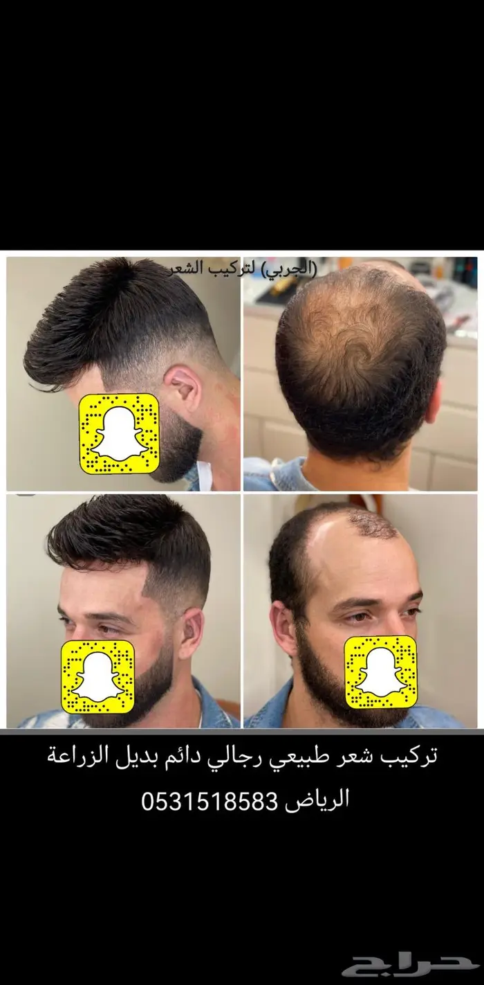 بديل الزراعه لصق شعر طبيعي دائم 6