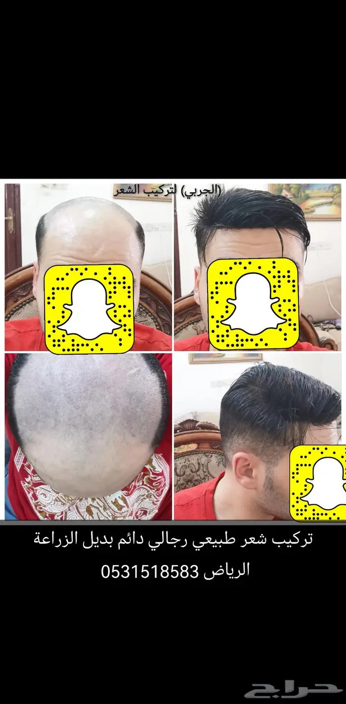 الصلع تركيب شعر اوروبي دائم 8
