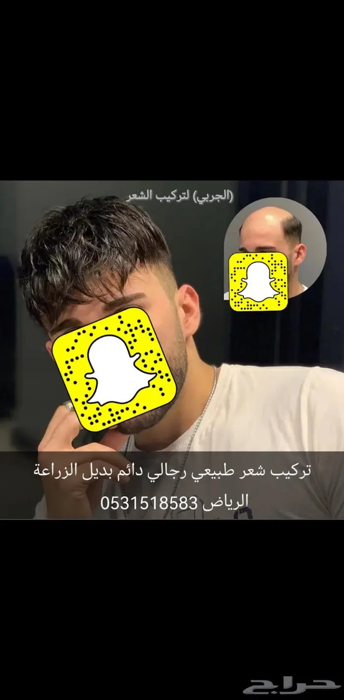 الصلع تركيب شعر اوروبي دائم 9