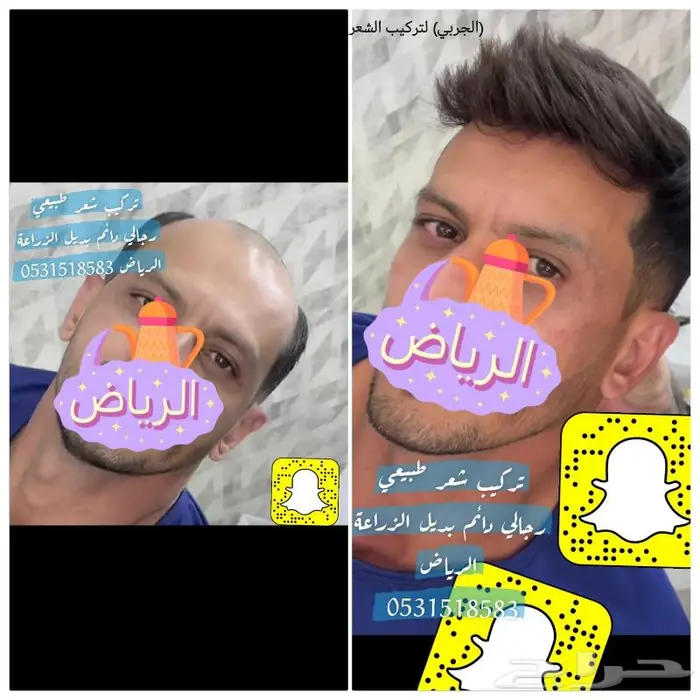 الصلع تركيب شعر اوروبي دائم 6