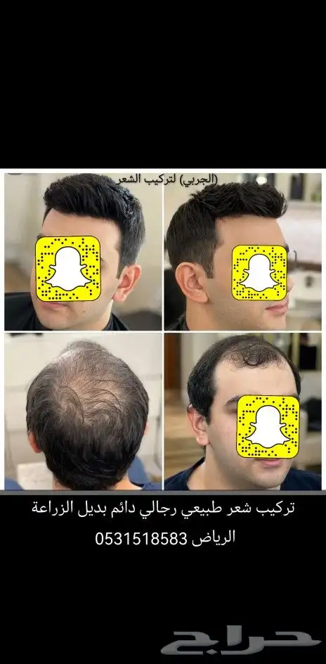 حل الصلع والثعلبه تركيب بديل الزراعة 4
