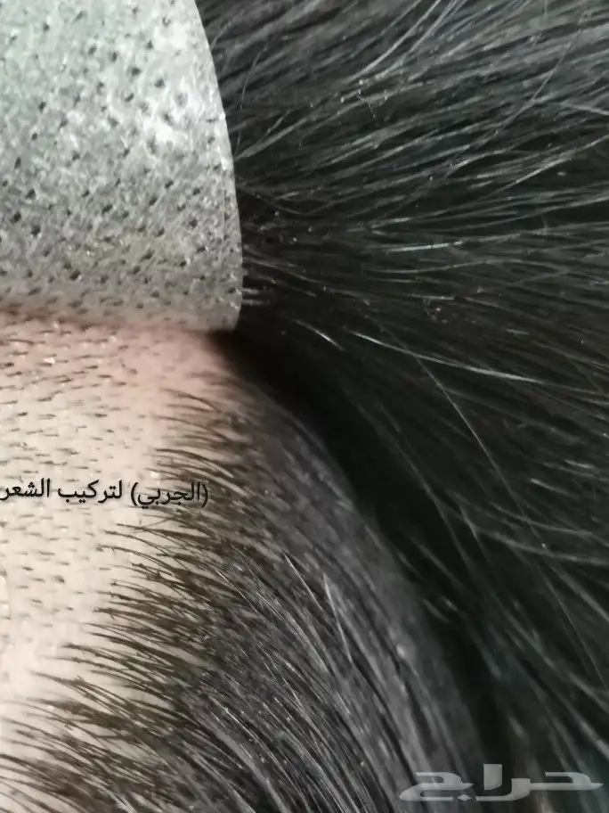 حل الصلع والثعلبه تركيب بديل الزراعة 7