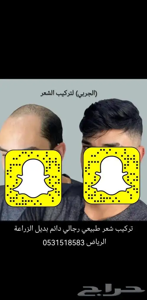 باروكة دائمة مكان الصلع بوستيجة 17