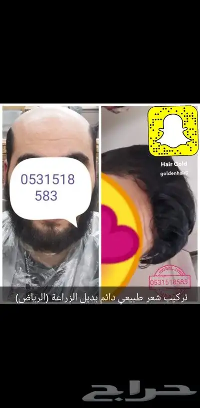 تركيب شعر دائم رجالي طبيعي بشري 9