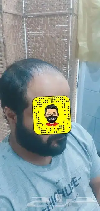 باروكه تركيب شعر طبيعي للرجل 0