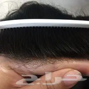 وداعا للصلع ووداعا للزراعة الحل الافضل 22