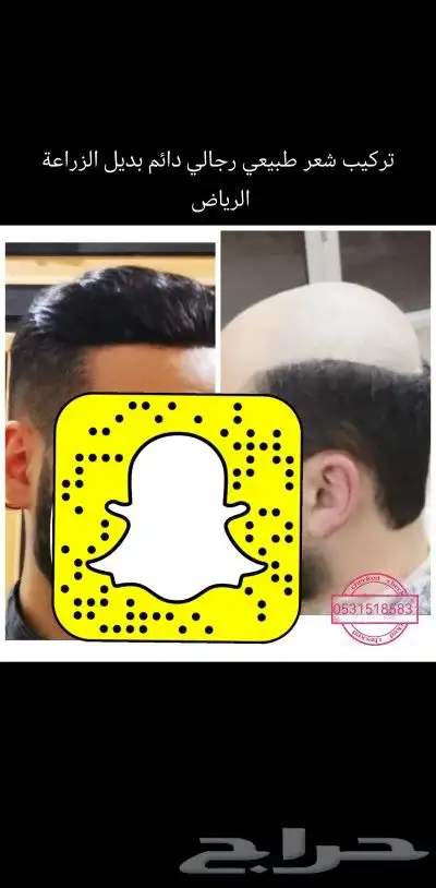 شعر بشري طبيعي لصق بديل الزراعة 12