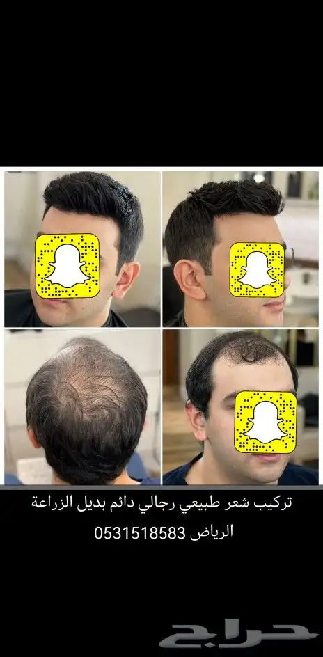 بديل الزراعة حل الصلع الدائم 2