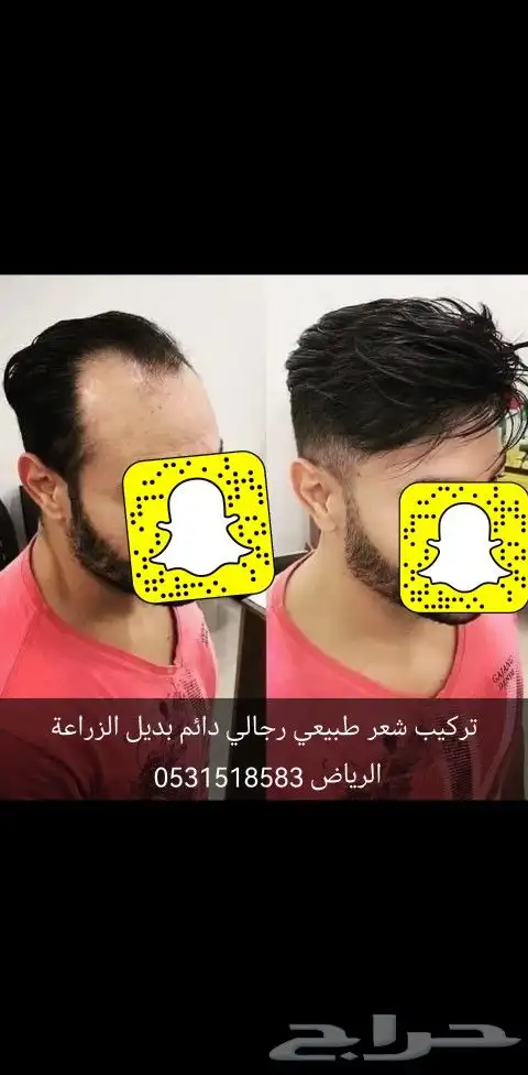 شعر بشري طبيعي لصق بديل الزراعة 7