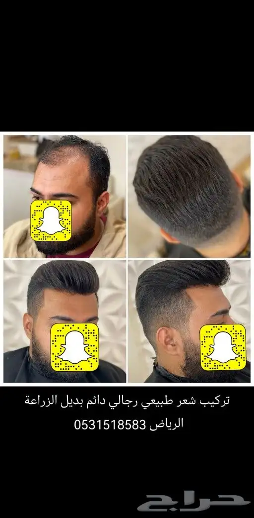 شعر بشري طبيعي لصق بديل الزراعة 1