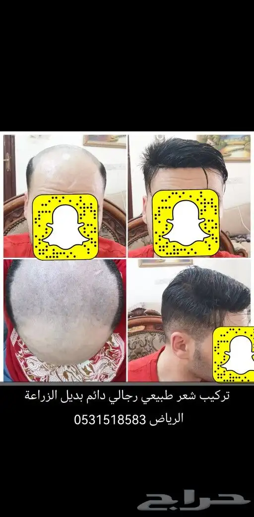 شعر بشري طبيعي لصق بديل الزراعة 9