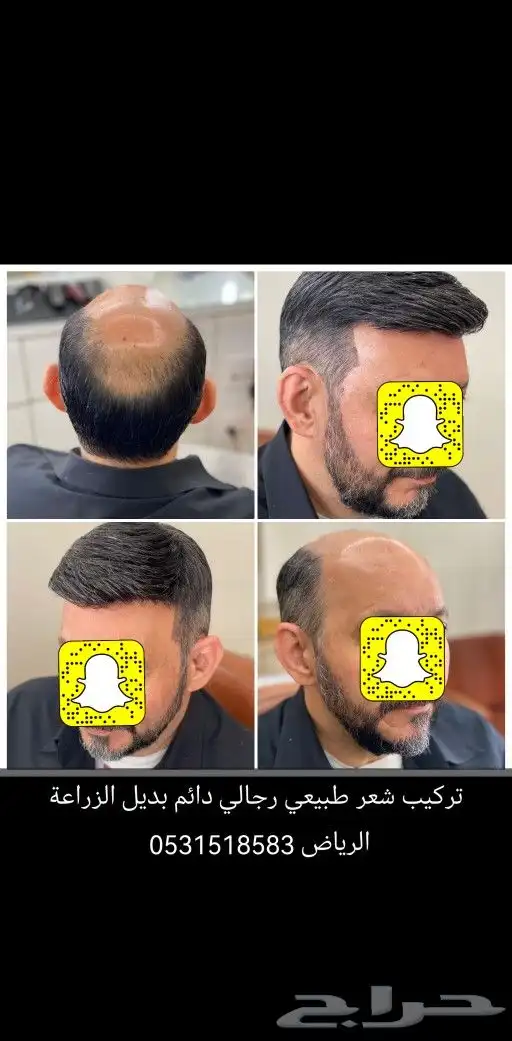 شعر بشري طبيعي لصق بديل الزراعة 4