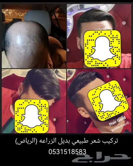 شعر بشري طبيعي لصق بديل الزراعة 13