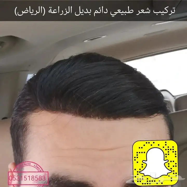 شعر بشري طبيعي لصق بديل الزراعة 15