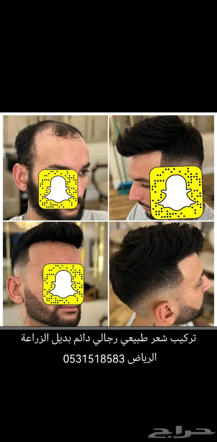 وداعا للصلع ووداعا للزراعة الحل الافضل 5