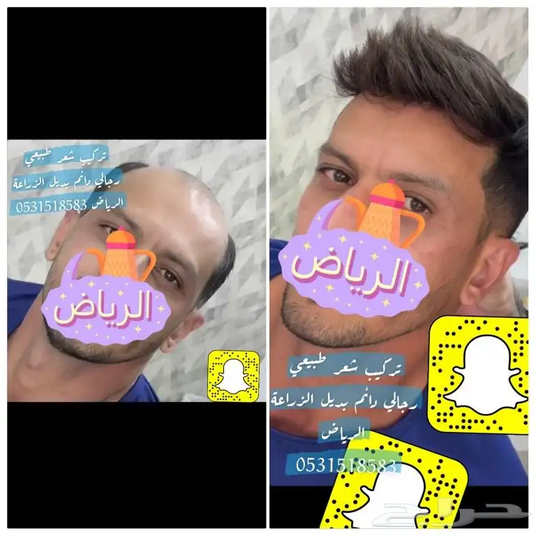 شعر بشري طبيعي لصق بديل الزراعة 10
