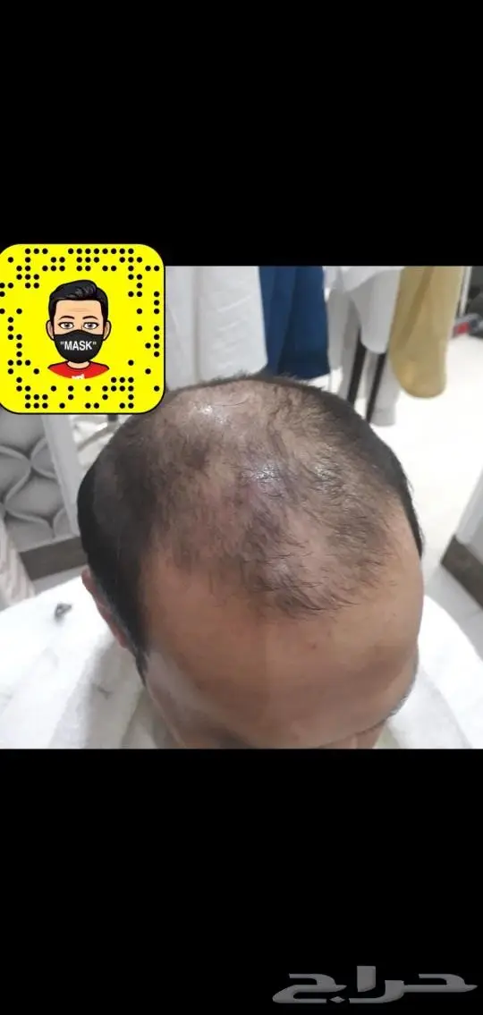 ابو يوسف تركيب شعر طبيعي المستعار للرجال 18