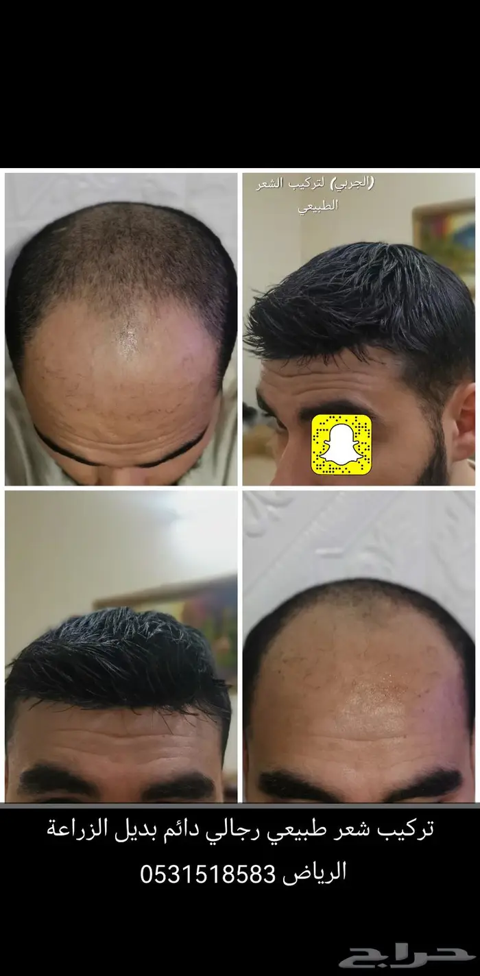 باروكة تركيب شعر طبيعي دائم 7