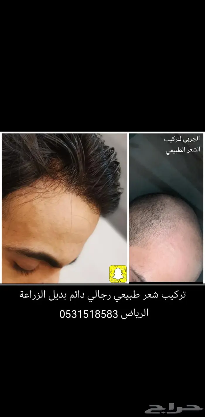 تركيب شعر رجالي بديل الزراعة 2