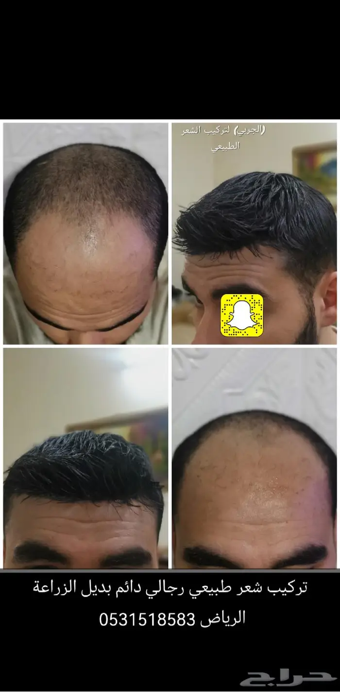 تركيب شعر طبيعي رجالي دائم بديل الزراعة 4