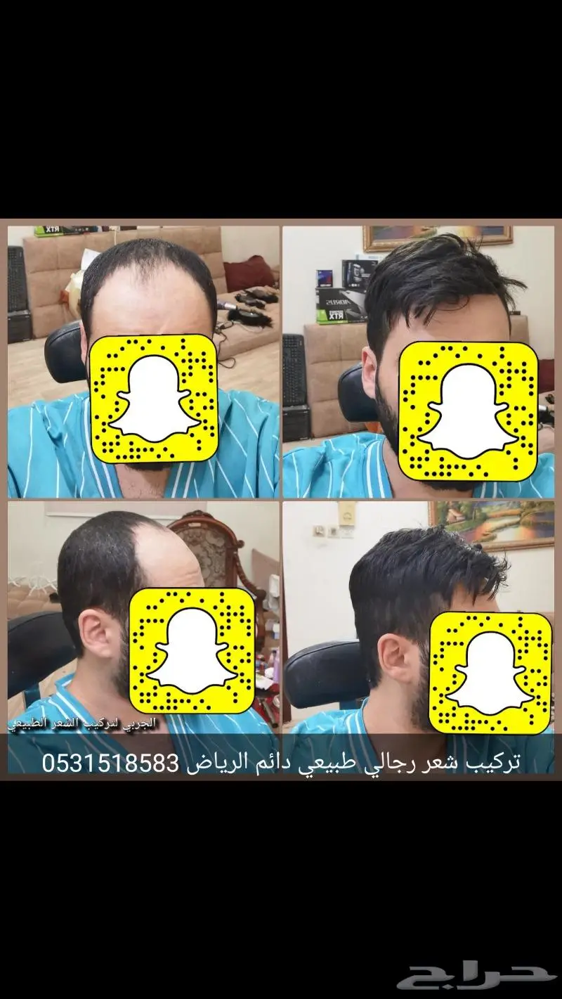 تركيب شعر رجالي دائم طبيعي 0