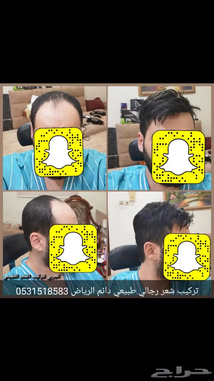 حل الصلع النهائي شعر طبيعي دائم 0
