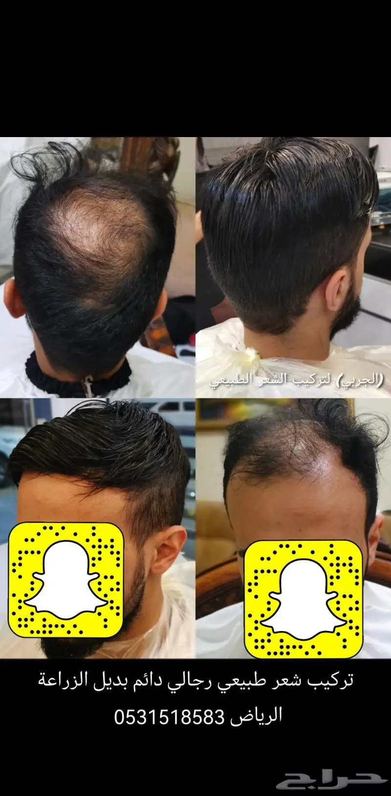 تركيب شعر رجالي دائم طبيعي 1