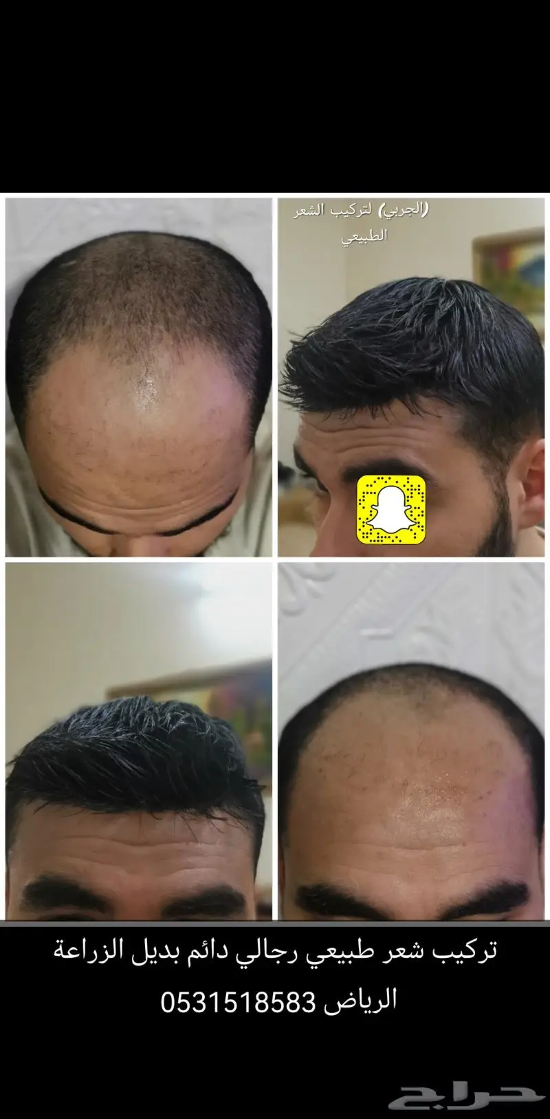 تركيب شعر رجالي دائم طبيعي 2