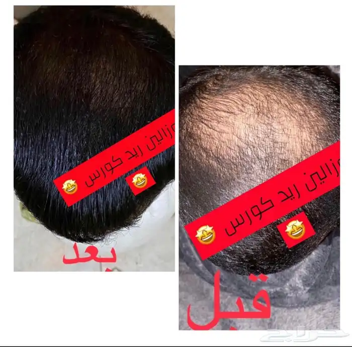 مفعول سحري زيت يساعد على انبات الشعر الدقن والراس 1