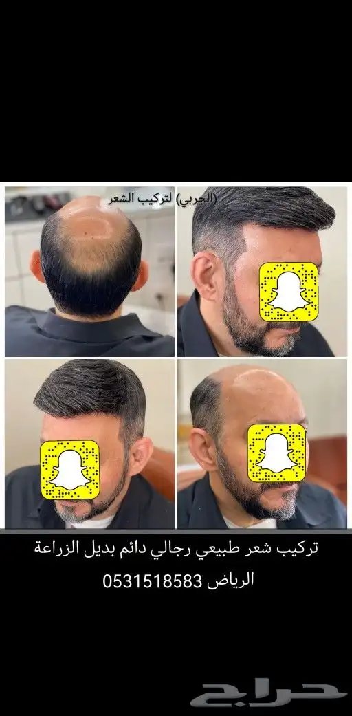 تركيب شعر طبيعي رجالي دائم بديل الزراعة 5
