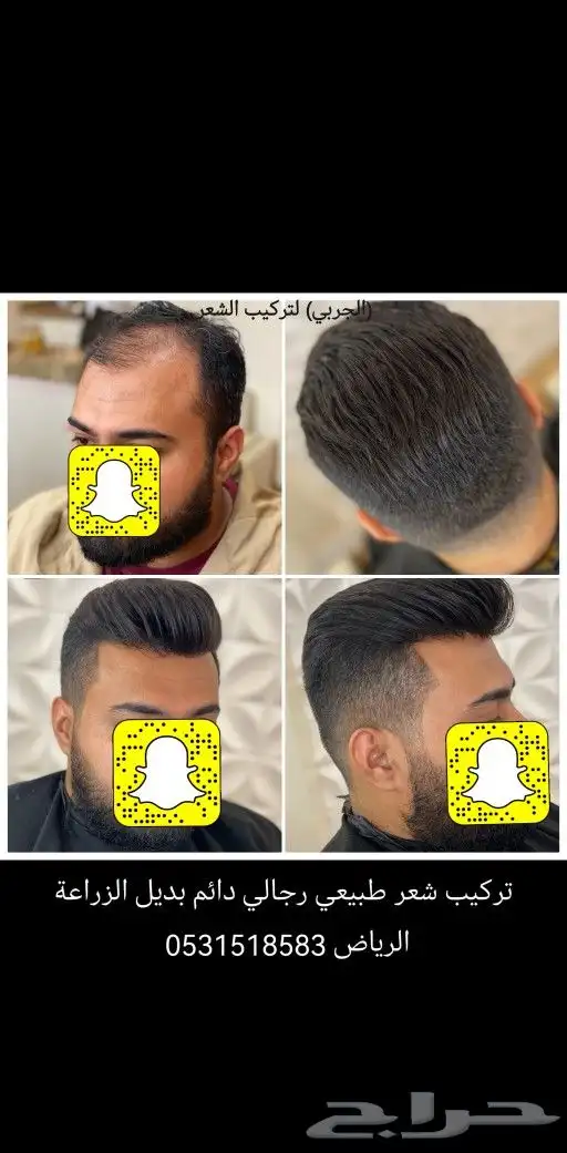 تركيب شعر طبيعي رجالي دائم بديل الزراعة 9
