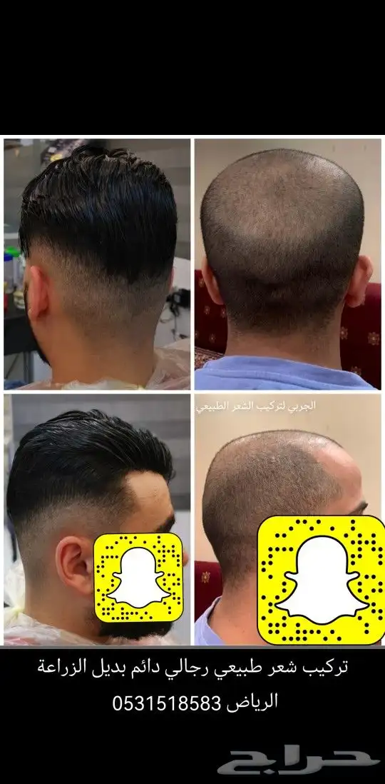 تركيب شعر طبيعي رجالي دائم بديل الزراعة 5