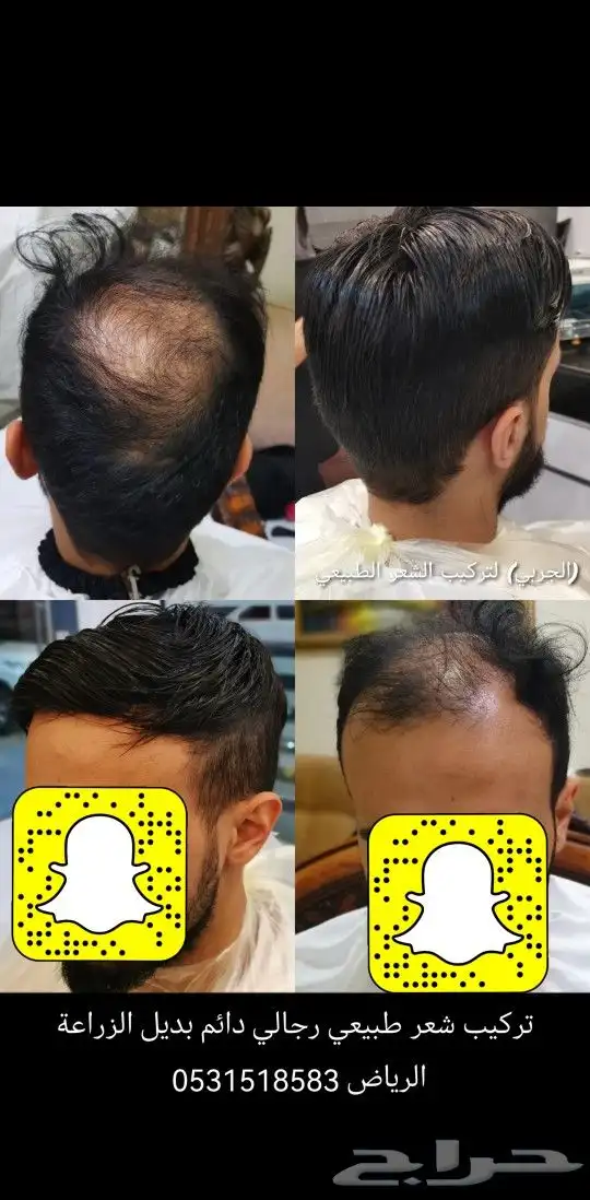 تركيب شعر طبيعي رجالي دائم بديل الزراعة 6