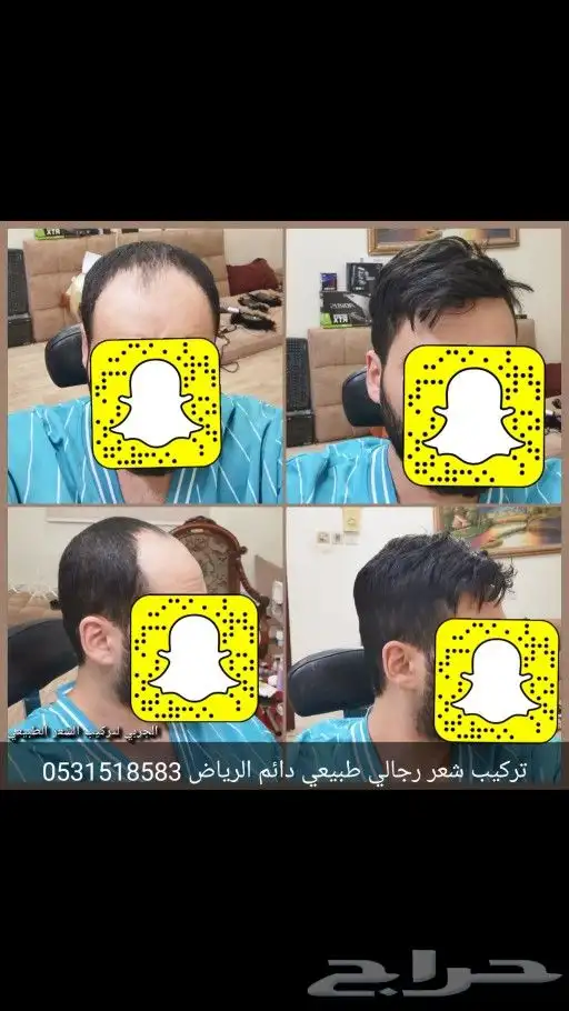 تركيب شعر طبيعي دائم اصلي بديل الزراعه 0