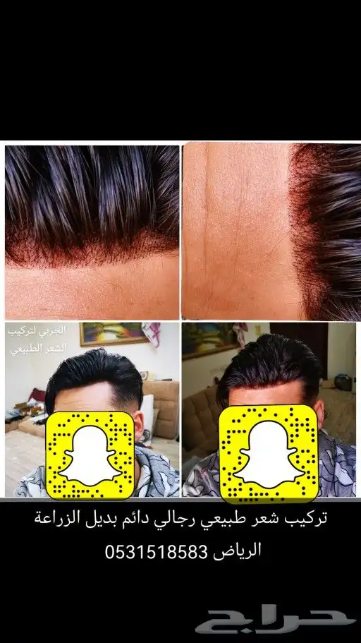 تركيب شعر طبيعي دائم اصلي بديل الزراعه 8