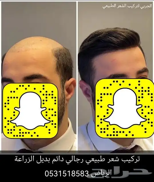 تركيب شعر طبيعي دائم اصلي بديل الزراعه 1