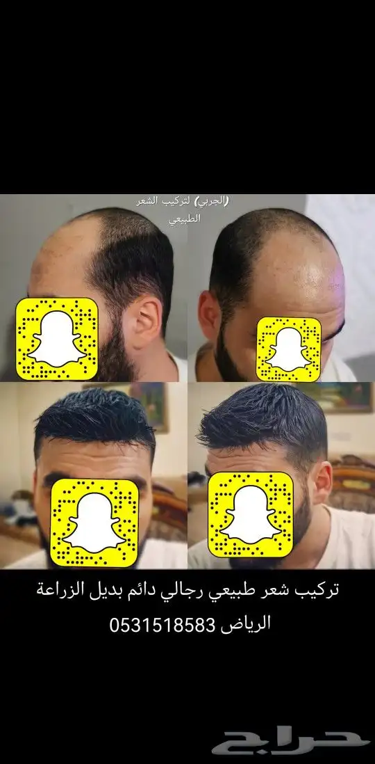 تركيب شعر طبيعي دائم اصلي بديل الزراعه 9