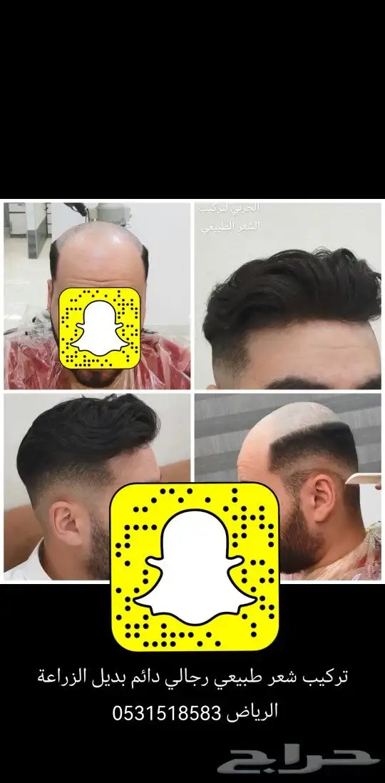 تركيب شعر طبيعي دائم اصلي بديل الزراعه 5