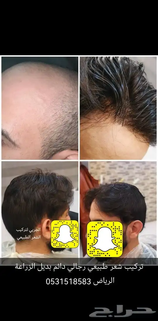 تركيب شعر طبيعي دائم اصلي بديل الزراعه 6