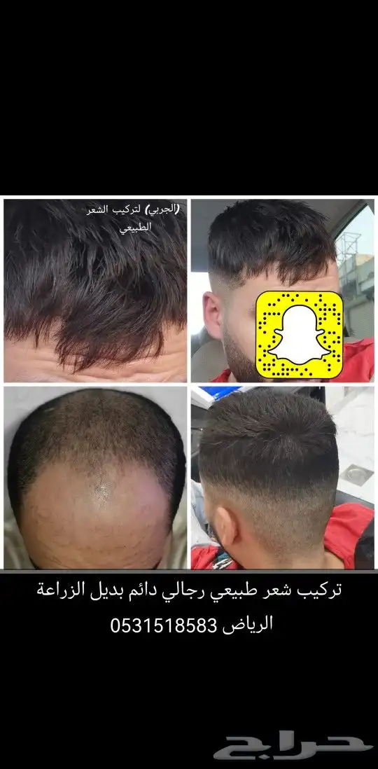 تركيب شعر طبيعي دائم اصلي بديل الزراعه 4