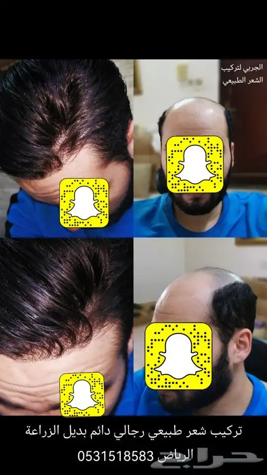 تركيب شعر طبيعي دائم اصلي بديل الزراعه 7