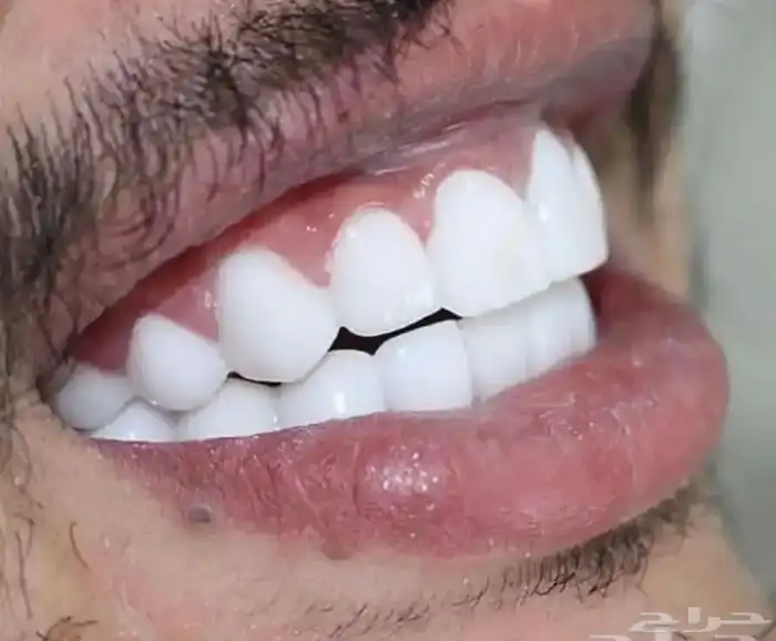 عروض على ابتسامة هوليود المتحركه اقساط 0