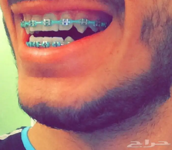 تقويم اسنان زينه 0