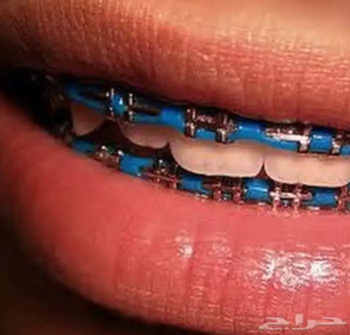 تقويم اسنان زينه 60 0