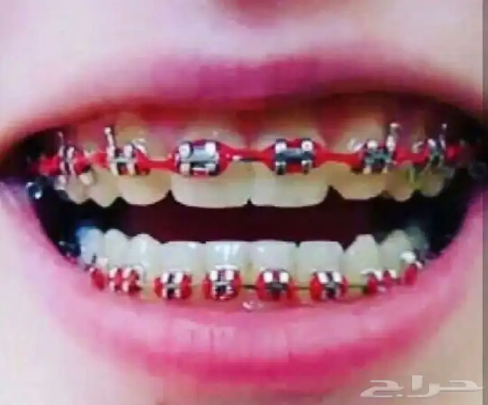 تقويم اسنان زينه 60 ريال 0