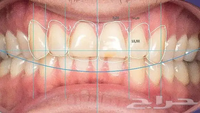 برنامج تصميم الاسنان - اكزوكاد Exocad بمناسبة العيد 100 ريال 1