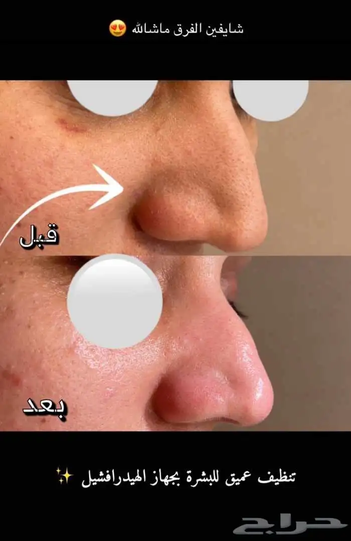 اكستنشن شعر طبيعي -تركيب -صيانه - معالجات للشعر والبشره 7