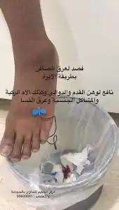 فصد عرق النسا والآم الظهر 0