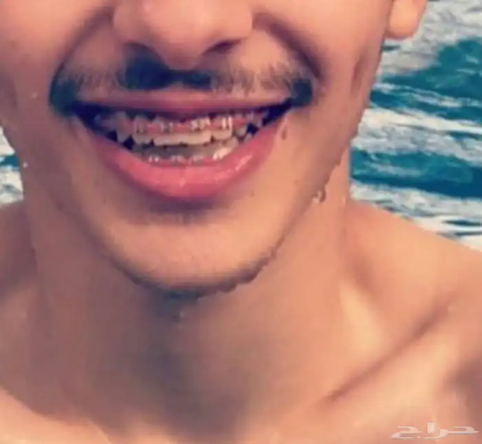 تقويم اسنان زينه 60 0