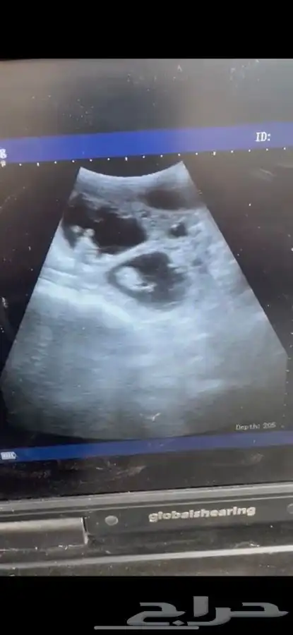 فحص سونار 0
